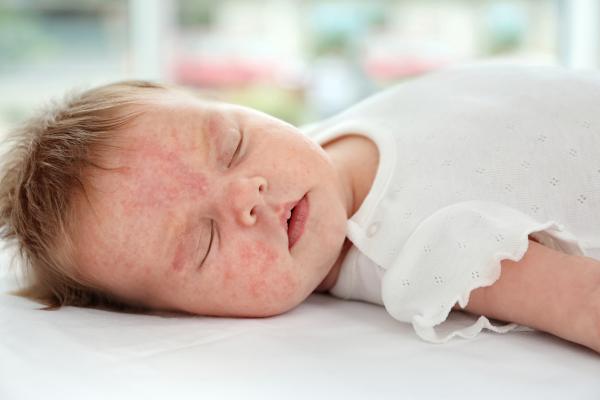 Eccema en bebés o dermatitis atópica: causas y tratamiento - ¿Cuáles son las causas del eczema en bebés?