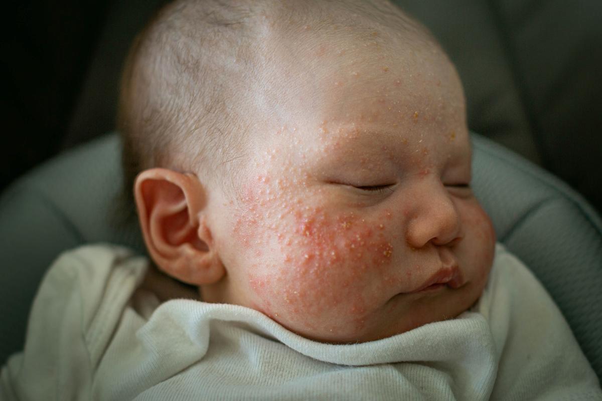 Eccema en bebés o dermatitis atópica: causas y tratamiento