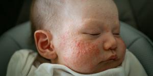 Eccema en bebés o dermatitis atópica: causas y tratamiento