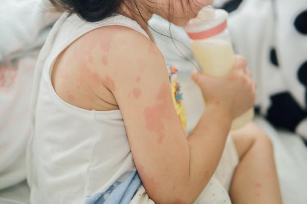 Eccema en bebés o dermatitis atópica: causas y tratamiento - ¿Qué tipos de dermatitis en bebés hay?