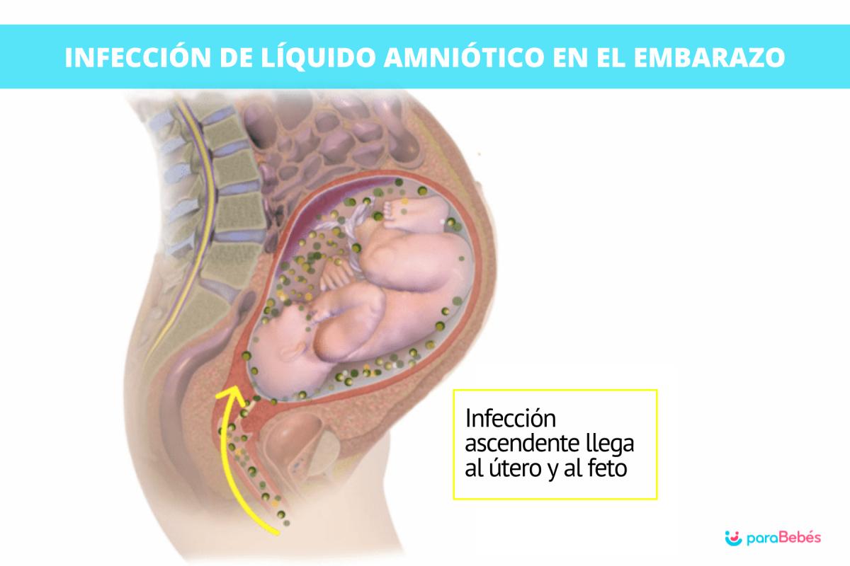 ¿Qué pasa si el líquido amniótico tiene infección?