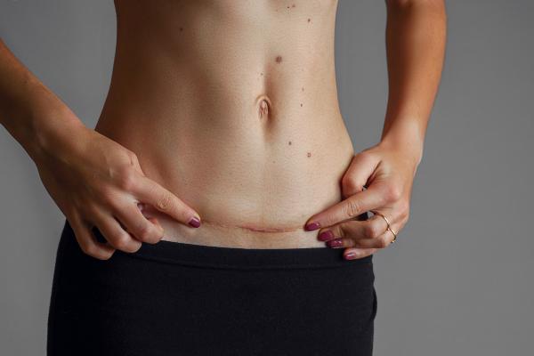 ¿Se puede abrir una cesárea después de 3 meses? - ¿Cómo saber si se me abrió la herida de la cesárea?