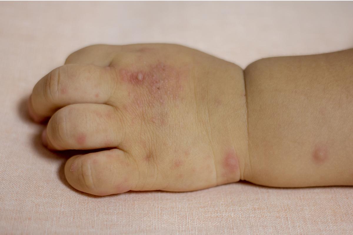 Moluscos contagiosos en niños: qué son, causas y cómo eliminarlos