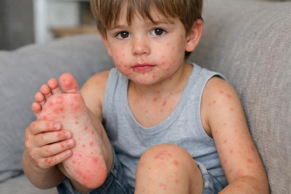 Virus boca-mano-pies en niños: tratamiento, contagio y síntomas - ¿Cómo empieza el virus boca-mano-pies en niños?