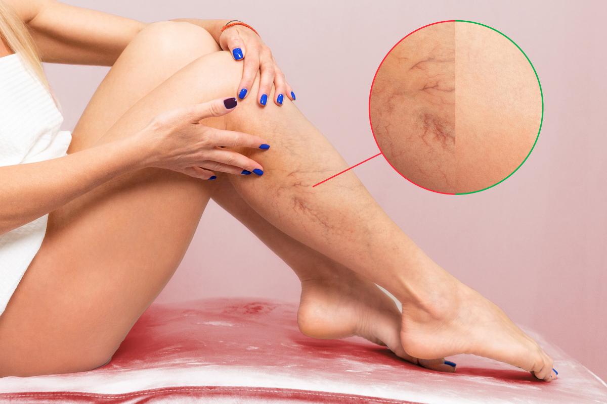 Varices en el embarazo: causas, tratamiento y cómo prevenirlas