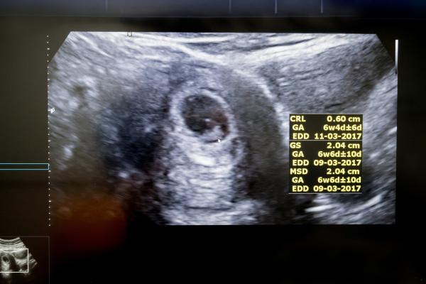 ¿A partir de qué semana se ve el saco gestacional? - ¿Por qué no se ve el saco gestacional a las 5 o 6 semanas?