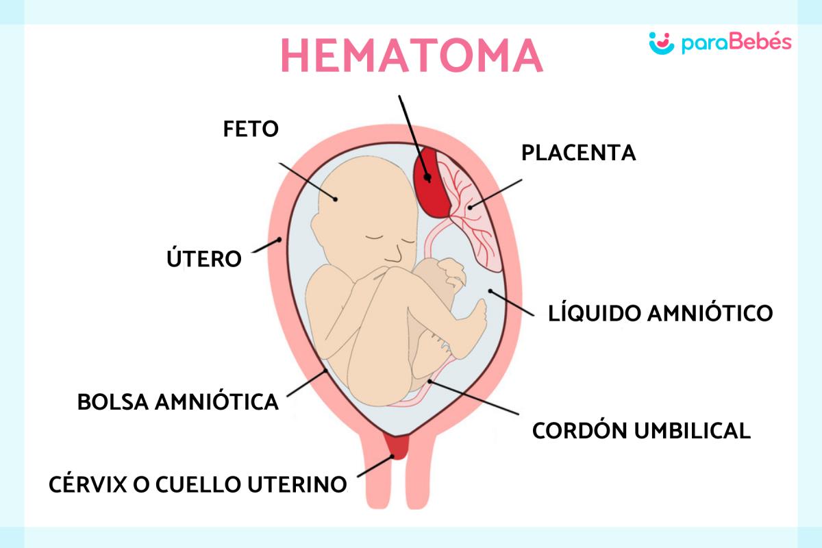 Hematoma en el útero en el embarazo: síntomas, causas y tratamiento