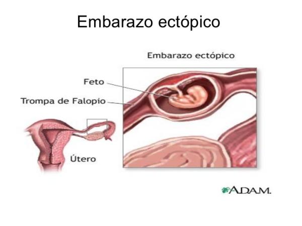 Embarazo ectópico: síntomas, causas y tratamiento - Causas del embarazo ectópico