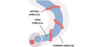 Arteria umbilical única: síntomas, consecuencias y tratamiento