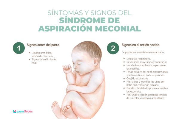Síndrome de aspiración meconial: signos y complicaciones