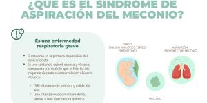 Síndrome de aspiración meconial: signos y complicaciones