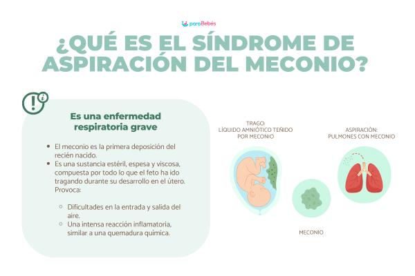 Síndrome de aspiración meconial: signos y complicaciones