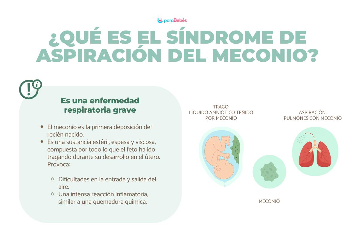 Síndrome de aspiración meconial: signos y complicaciones