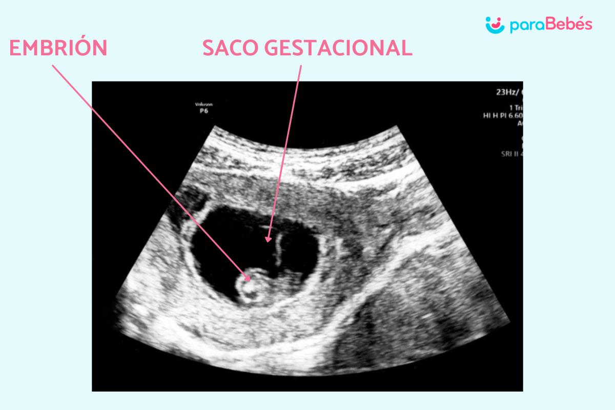 Qué es el saco gestacional y cuánto mide