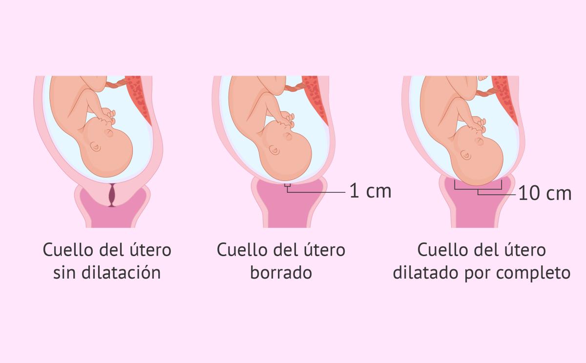 Qué es el borramiento cervical y cómo medirlo