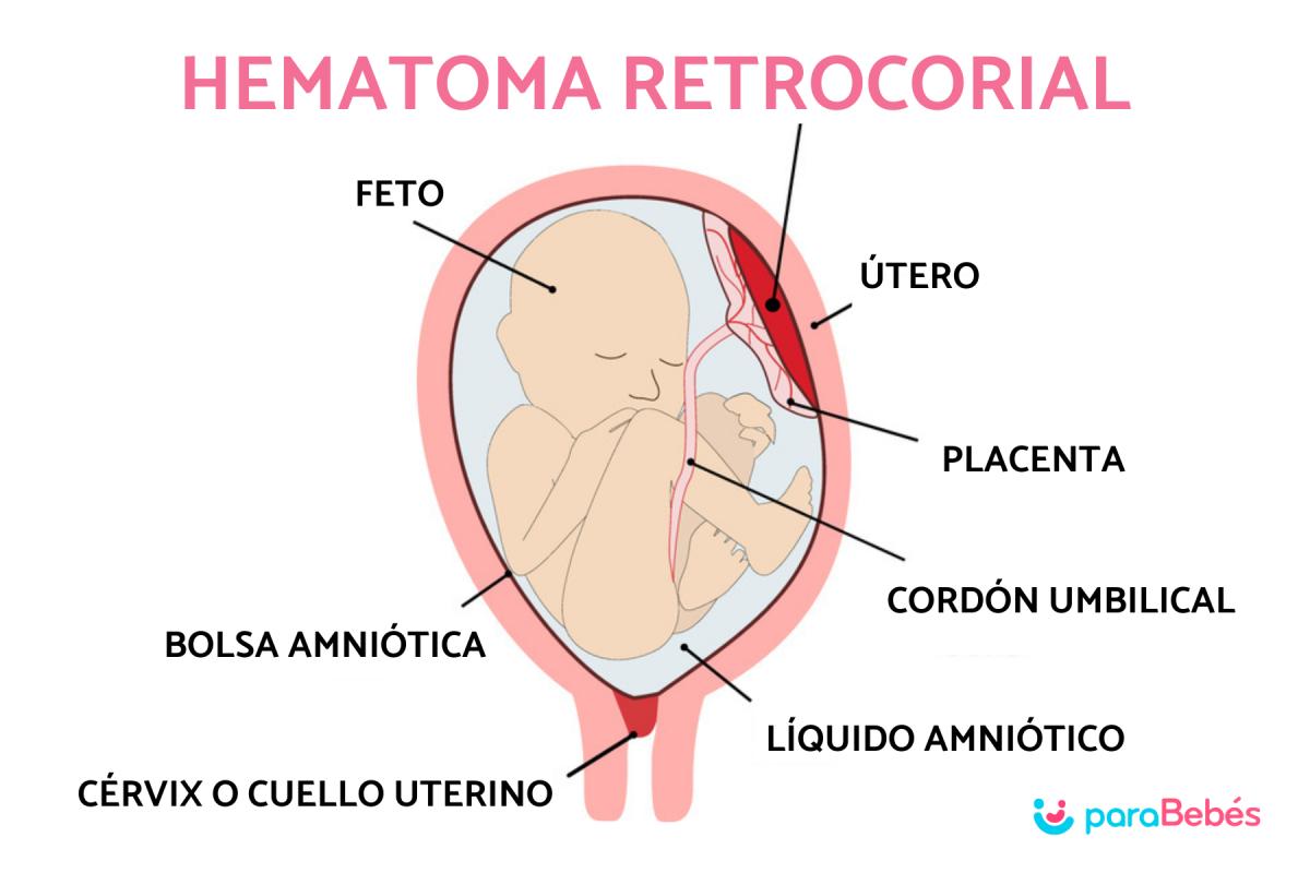 Hematoma retrocorial en el embarazo: qué es, causas, síntomas y cómo eliminarlo