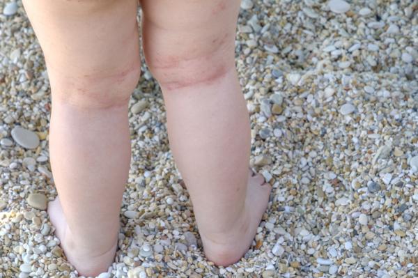Sarpullido en bebés: causas y tratamiento - Dermatitis atópica