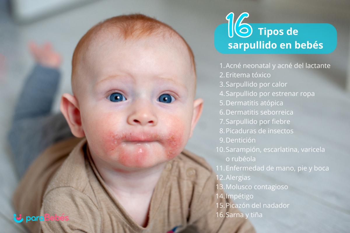 Sarpullido en bebés: Tipos, causas y tratamiento