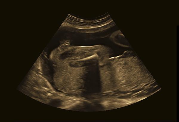 Eclampsia: causas, síntomas y tratamiento - Posibles complicaciones de la eclampsia