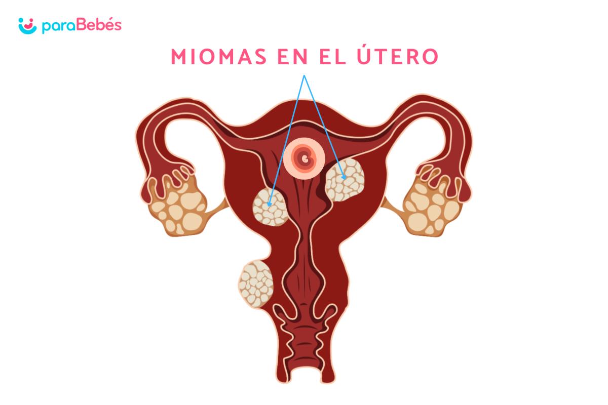 Qué pasa si tengo miomas en el útero y estoy embarazada