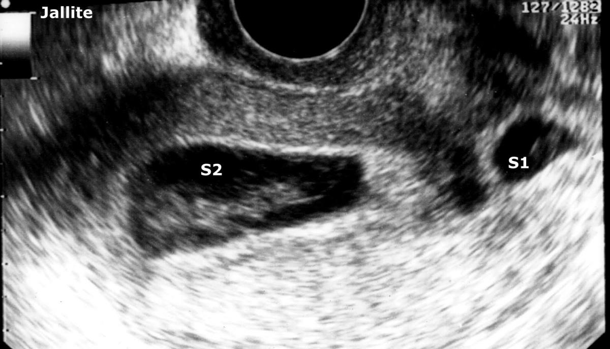 Qué pasa si estoy embarazada de dos sacos gestacionales, uno vacío y otro con embrión
